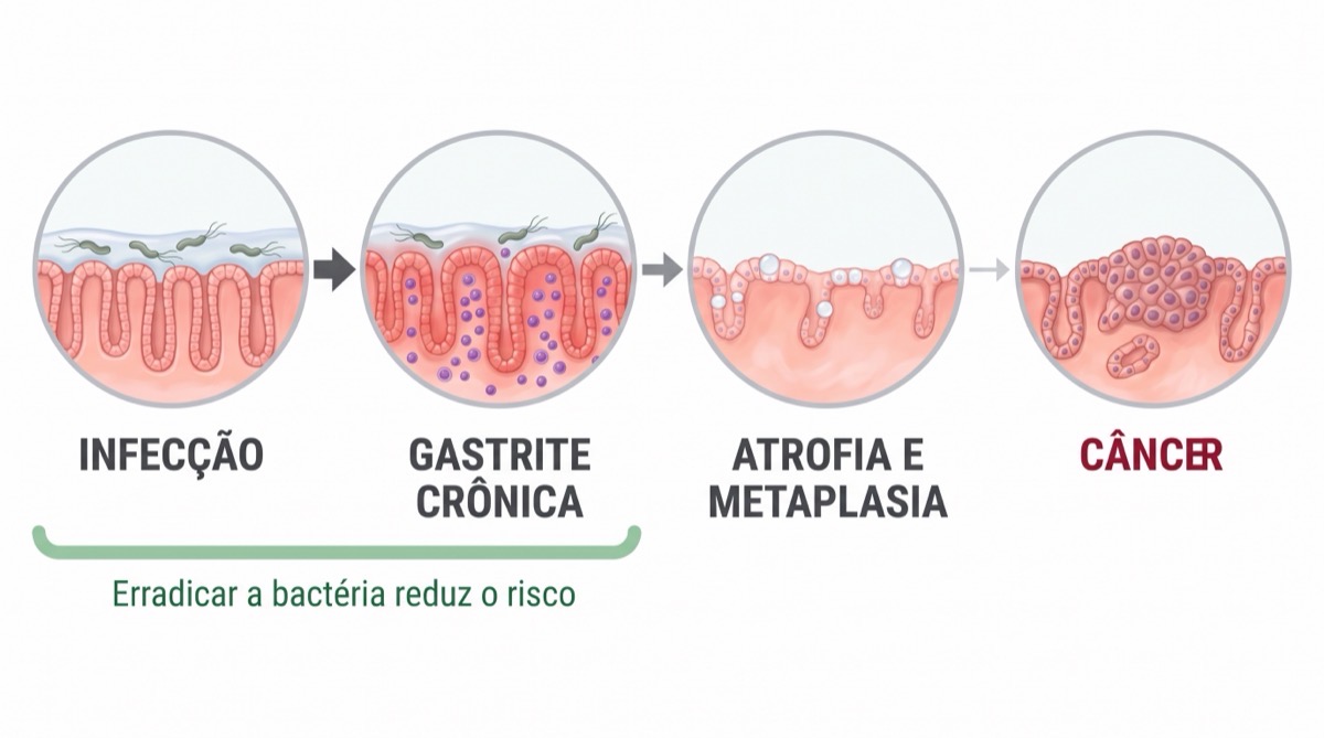 H. pylori e câncer de estômago, entenda o risco de verdade e o que fazer para reduzi-lo